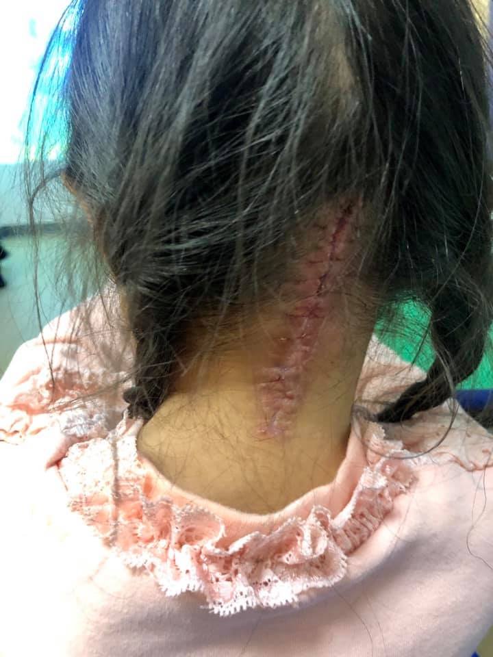 Lei Hang's daughter Yasmin had a decompression operation for Chiari Malformation. Yasmin shows her long scar behind her head.